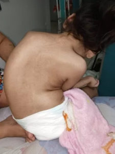 Sem cirurgias, crianças com microcefalia por zika sofrem com dores intensas