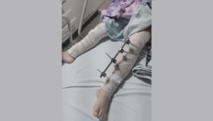 Erro médico: criança tem pinos colocados em perna errada