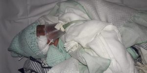 Morre bebê prematuro que respirava com copo plástico improvisado