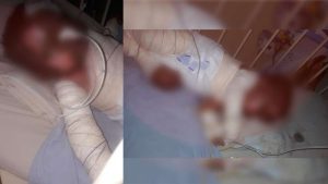 Casa pega fogo e bebê fica gravemente queimado no Marajó