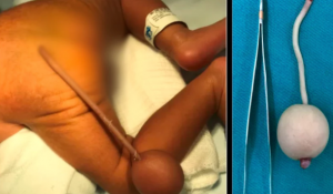 Bebê brasileiro nasce com cauda de 12 cm e bola de 4 cm na extremidade