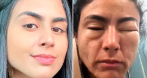 Estudante viraliza ao fazer post sobre episódio em que ficou com rosto deformado após comer camarões em Copacabana