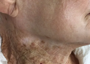 Idosa passou filtro solar por décadas no rosto, mas não no pescoço; veja imagem