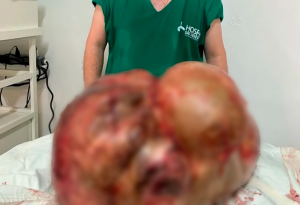 Morre mulher que teve tumor de 46 kg retirado em cirurgia de emergência em Itaperuna, no RJ