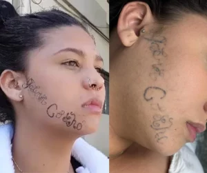 Um ano após ter rosto tatuado à força pelo ex, jovem segue tentando remover tatuagem e busca um recomeço: ‘Não tinha mais vontade de viver’