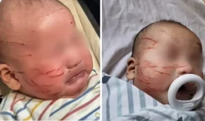 Bebê de 10 semanas volta da creche sangrando e com arranhões no rosto; mãe exige respostas