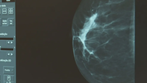 Estudo mostra que câncer de mama está se manifestando com maior frequência em mulheres abaixo dos 40 anos