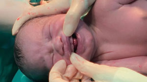 Bebê nasce com dentes e surpreende equipe médica no Mato Grosso do Sul